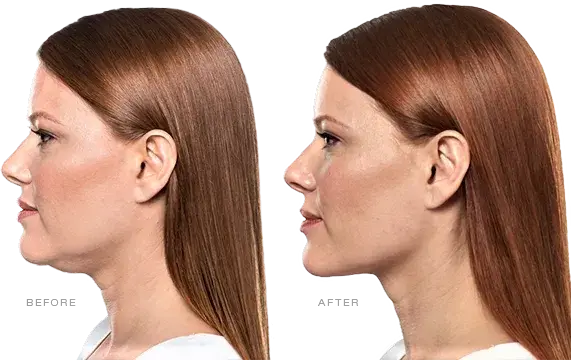 Photo of Kybella treatment results