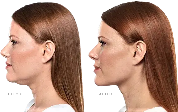 Kybella treatment results