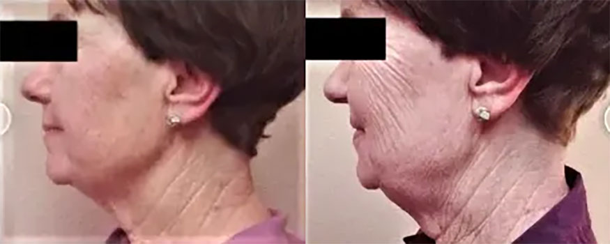 Before and After Photo