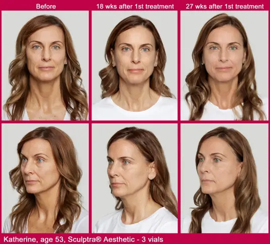Sculptra Collagen Treatment - Before and After