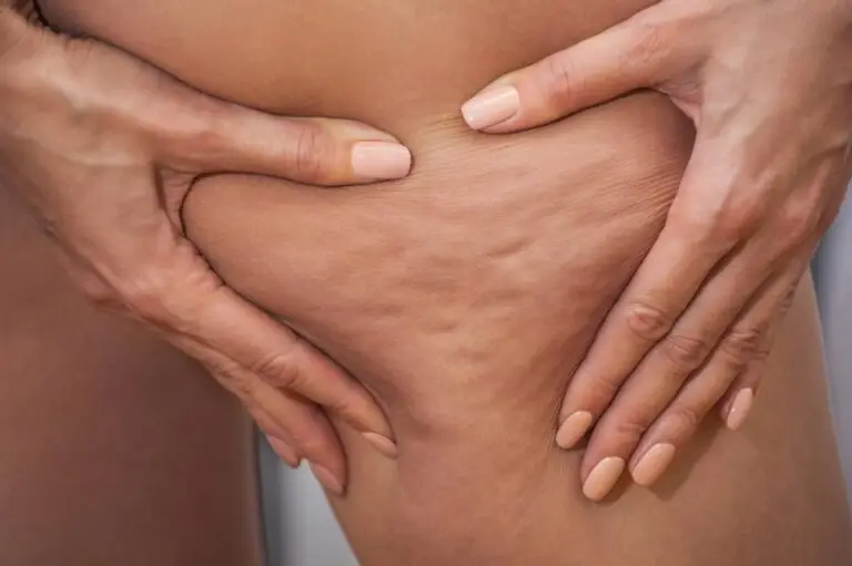 Cellulite can be treated at NAWI Wellness, Naples, FL