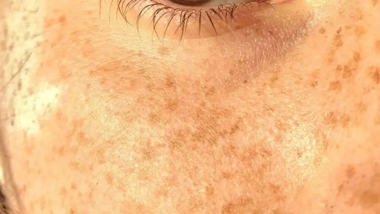 Sun damaged skin