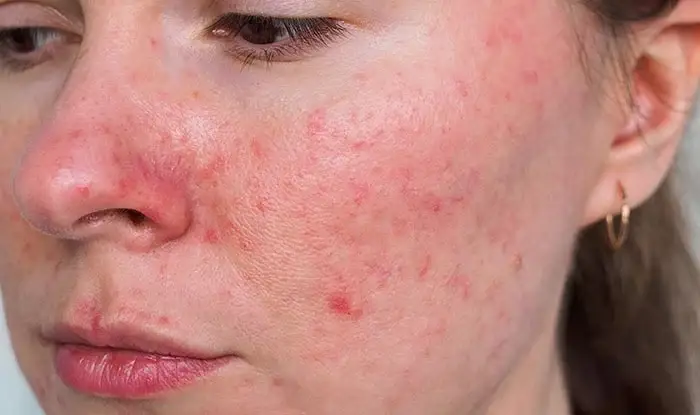 rosacea