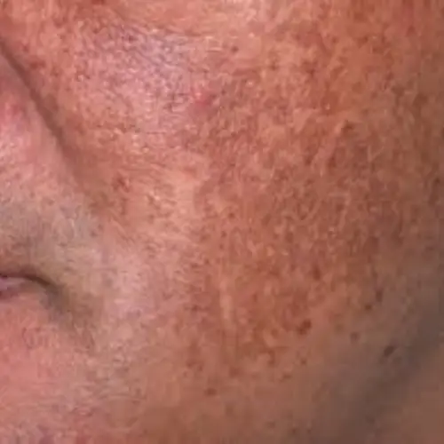 Melasma can be treated by NAWI Wellness, Naples, FL