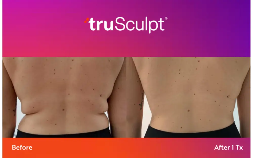 Trusculpt body sculpting results - before and after at NAWI Wellness, Naples, FL