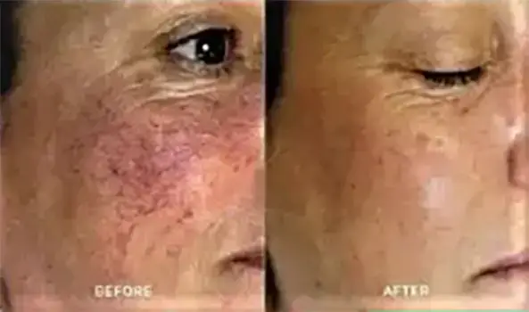 IPL Photofacial Treatment delivers real results at NAWI Wellness, Naples, FL