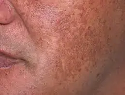 Melasma treatment is available at NAWI Wellness in Naples, FL