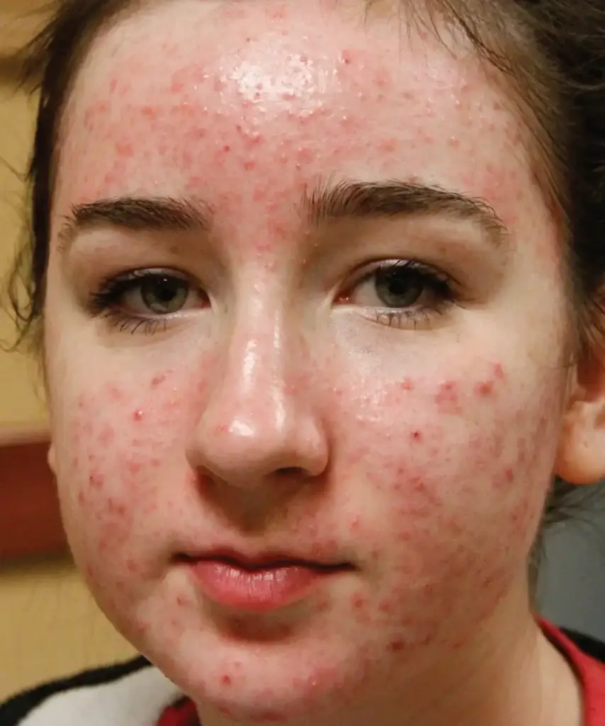 Moxi for acne - before treatment