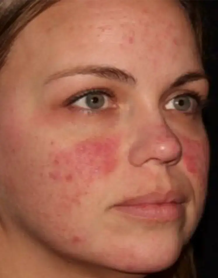 Moxi for rosacea - before treatment