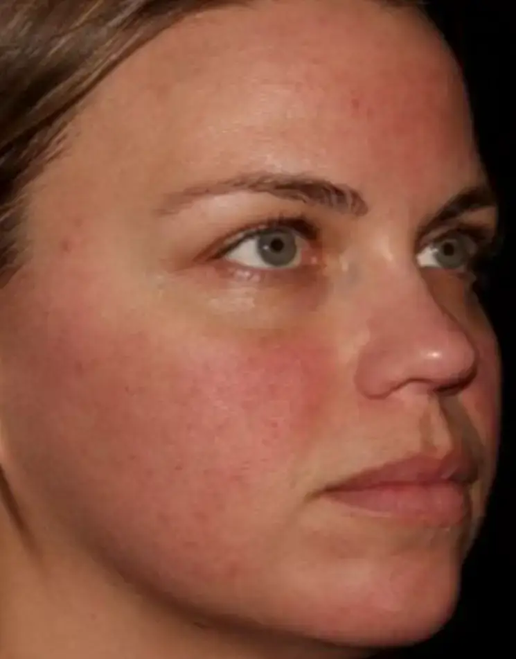 Moxi for rosacea - after treatment