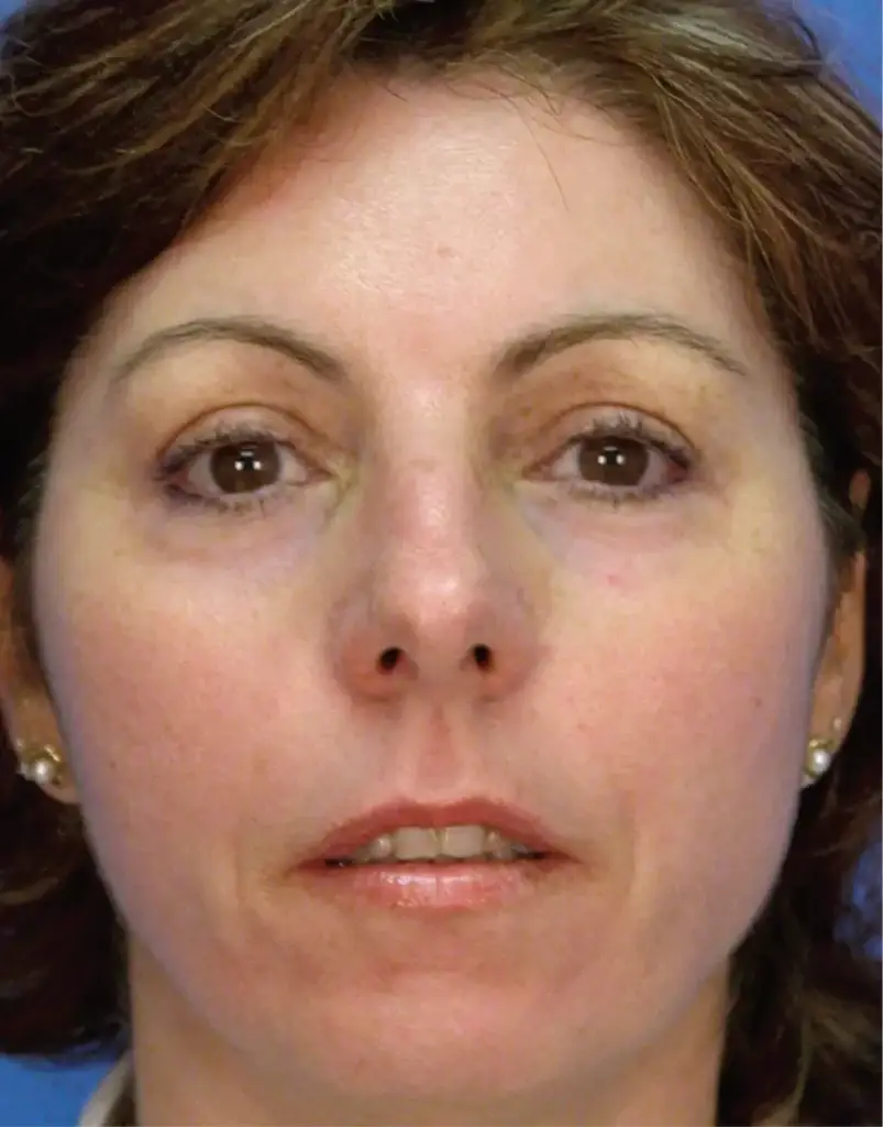 Moxi Laser After Treatment
