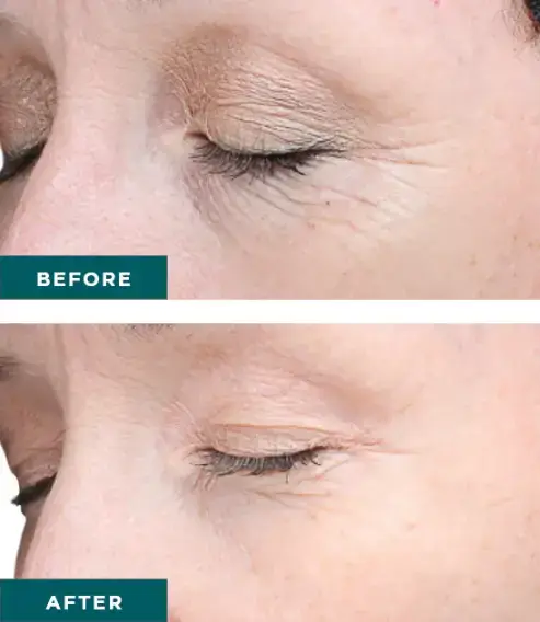 Chemical peels help address fine lines and wrinkles at NAWI Wellness, Naples, FL
