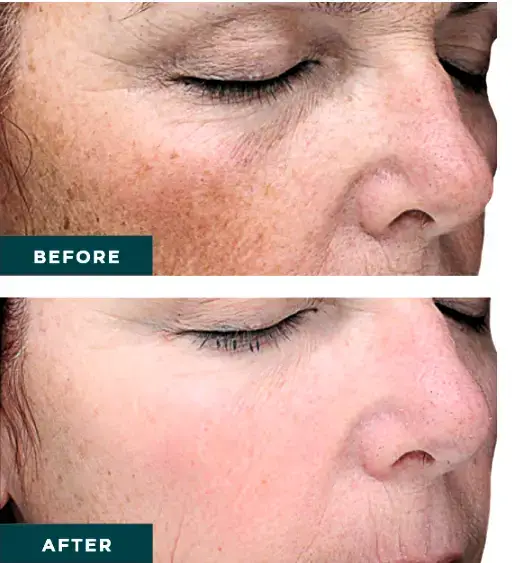 Chemical peels help to address brown spots and freckles at NAWI Wellness, Naples, FL