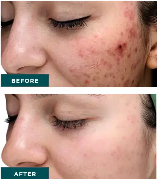 Chemical Peels help to address acne at NAWI Wellness, Naples, FL