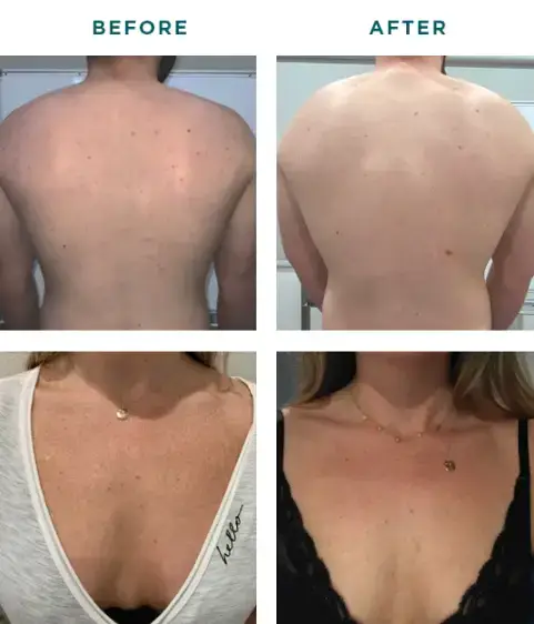 Chemical peels can be used on the back and chest at NAWI Wellness, Naples, FL