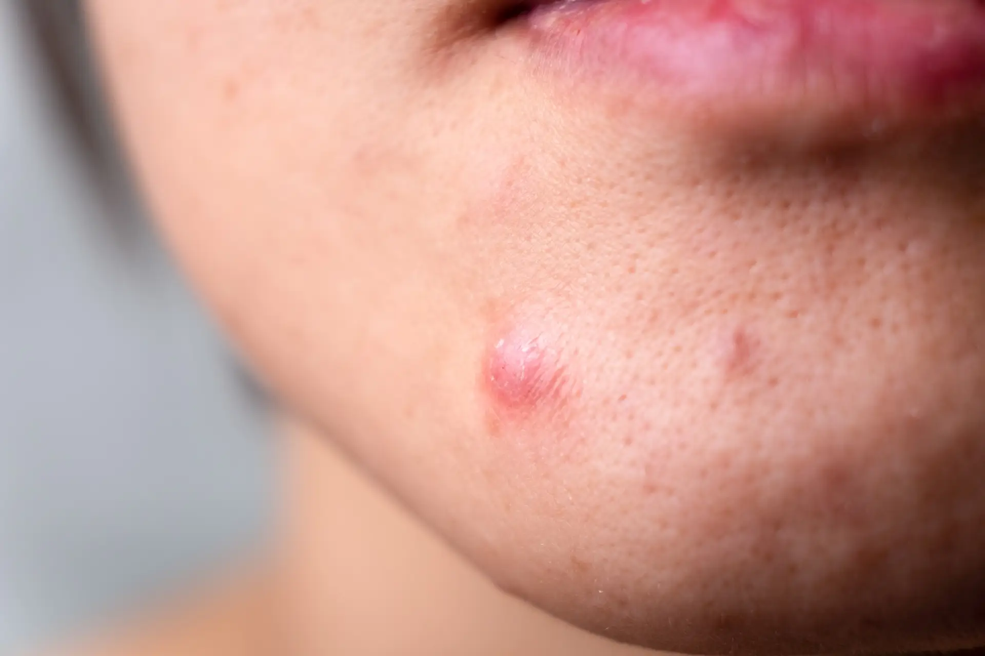 Active acne treatment at NAWI Wellness, Naples, FL