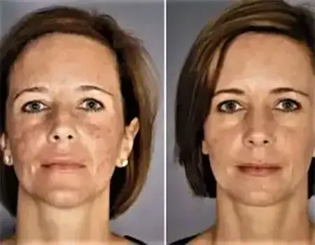Juliet Erbium Laser Treatment to address acne scarring at NAWI Wellness in Naples, FL