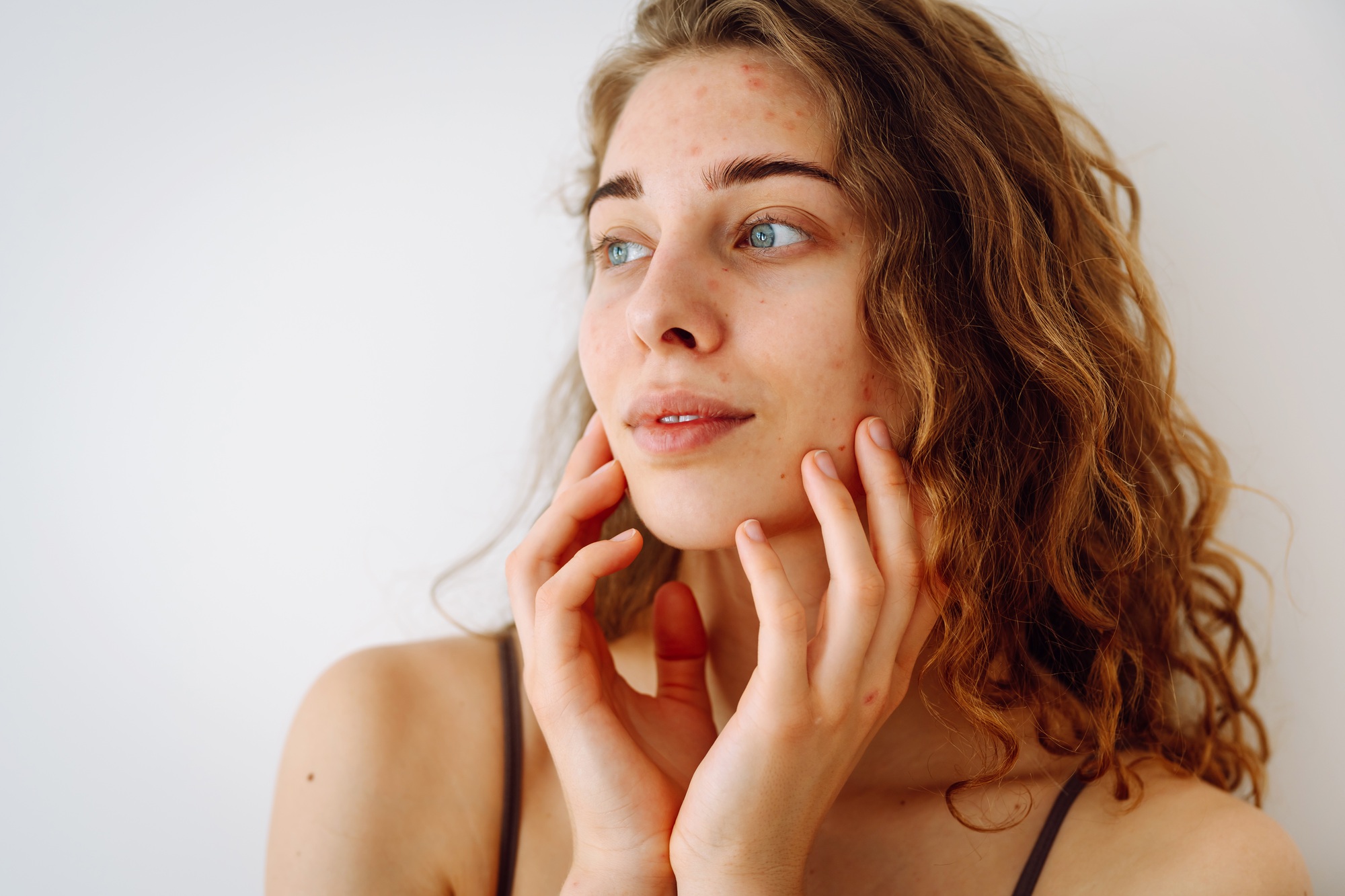 Portrait of beautiful young woman with inflammations on skin of her face. Medicine and cosmetology.