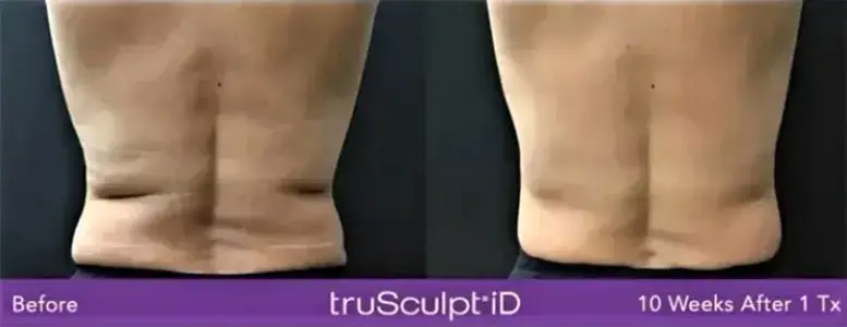 Trusculpt Body Sculpting for Men is available at NAWI Wellness in Naples, FL