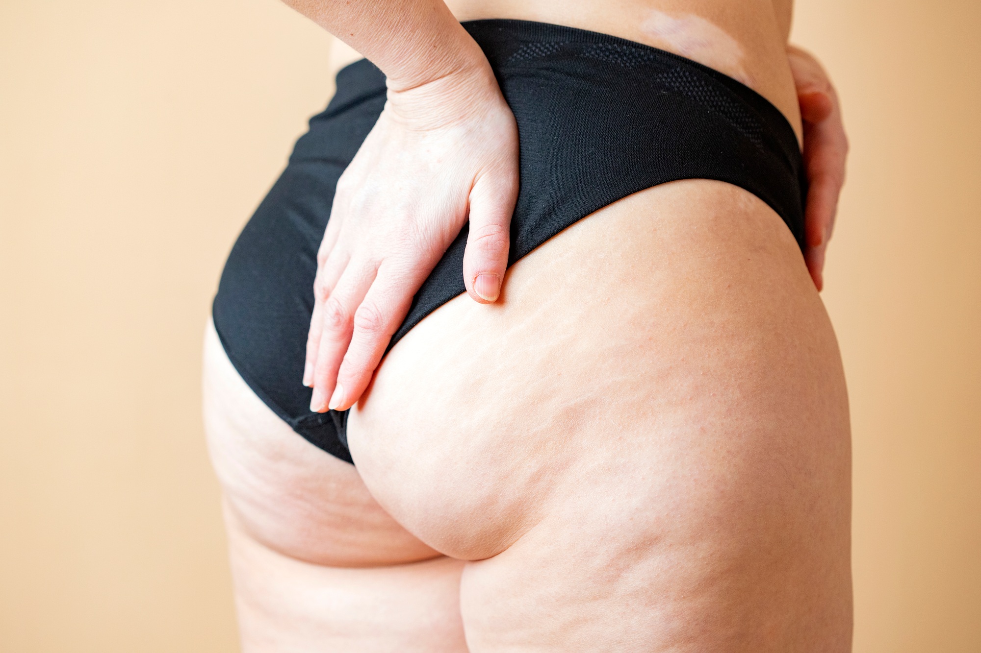 Woman with cellulite on beige background, closeup.