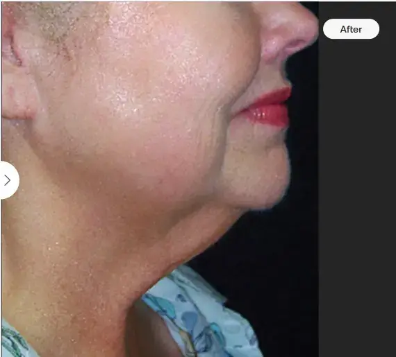 More youthful skin on the neck after skintyte treatment