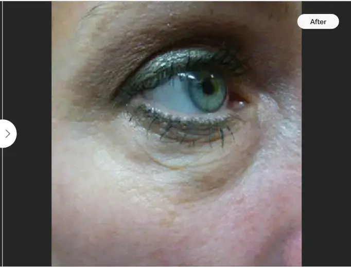 More youthful skin after skintyte treatment