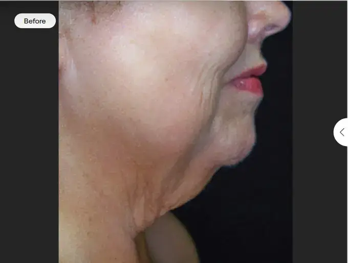 Loose skin on the neck before skintyte treatment