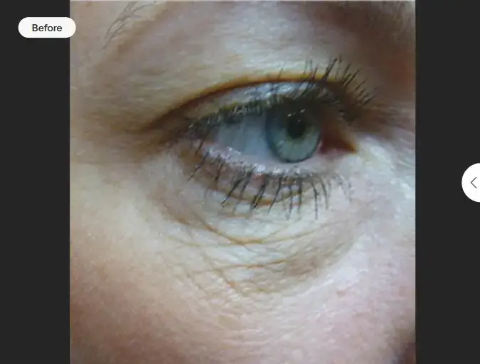 Loose skin before Skintytpe treatment