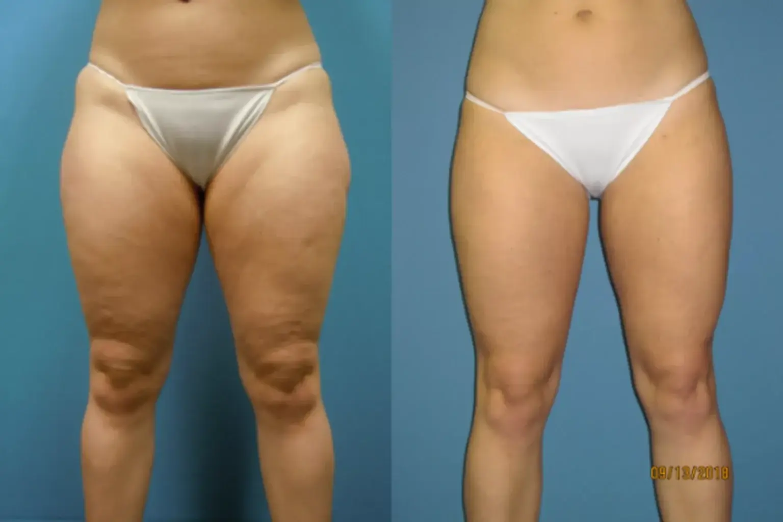 Microneedling to remove loose skin is offered at NAWI Wellness, Naples, FL